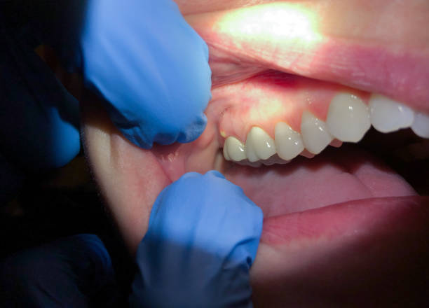 Best Urgent Tooth Repair  in Carthage, MO